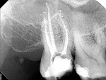 Figure 18  This re-treatment of a maxillary second molar shows the pretreatment radiograph and the postoperative result. Note that the SAF was able to maintain the delicate apical anatomy present in the apical third of the roots. (Cases treated by Dr