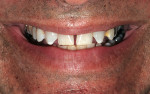 Figure 1  Spaces, color, and improper tooth contours were the patient’s major complaints.