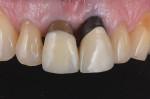 Fig 1. The maxillary central incisors exhibited gingival recession, “black holes,” flat interdental papilla, dark roots, thin periodontal biotype, and an uneven gingival line with grade 3 mobility (clinically).