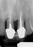 Fig 2. Periapical radiograph. More than 60% bone loss was noticeable. The four incisors
were splinted due to excessive mobility of the centrals.