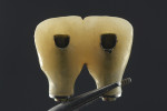 Fig 9. Provisional restoration. Acrylic shells were connected chairside to titanium sleeves for screw-retained immediate provisionalization.
