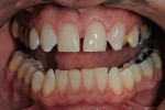 Figure 2  Treatment planning was for porcelain layered zirconia veneers and crowns keeping the materials consistent throughout the case.