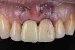 Fig 13. Provisional crowns connected. A cross-suture at No. 9 pulled the tissue coronally.