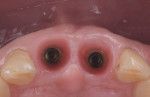 Fig 14. At 4 months the peri-implant mucosa exhibited a healthy appearance and adequate volume.