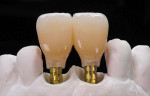 Fig 21. Definitive restoration. Splinted zirconia-based layered crowns were created (Fig 20) and connected to Ti-base sleeves (Fig 21) (technician: Giuseppe Romeo, MDT).