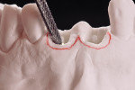 Fig 18. The tissue between the marking and the prosthetic platform was gently removed
to allow smooth continuity of the cervical prosthetic site.