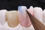 Fig 20. Definitive restoration. Splinted zirconia-based layered crowns were created (Fig 20) and connected to Ti-base sleeves (Fig 21) (technician: Giuseppe Romeo, MDT).