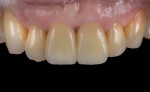 Fig 24. At 2 weeks the definitive crowns integrated well with the surrounding mucosa and teeth.
