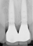 Fig 27. Periapical radiograph at 13 months depicted stable bone next to the implants. Note the relationship of the implant heads, bone, and Connect abutments as well as the whole implants-restorative contours.