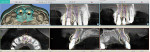 Fig 4. Virtual implant planning software. Implants positions were designed to engage maximum bone and allow for screw-retained restorations.