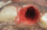 Fig 5. The supracrestal gingival complex around the tooth was severed with sharp dissection and root removal in a flapless manner.
