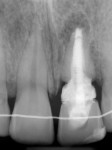 Fig 4. Preoperative periapical radiograph of tooth No. 9.