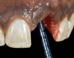 Fig 6. The 12-degree co-axis implant feature requires aligning the long axis of the drill shank toward the incisal edge of the adjacent teeth as a point of reference for osteotomy making. Solid extended shank drills were used to eliminate chattering and vibration during this process, leading to precise site preparation. Because only the apical one-half of the implant was being used for primary stability, this procedure must be performed accurately.