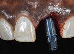 Fig 9. The implant was placed to the second black line from the midfacial free gingival margin designating 3 mm of implant depth and placement to the facial crest of bone. The orientation groove was aligned to the labial aspect with the screw access to the palatal.