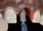 Fig 8. The implant was placed into the osteotomy site with an incisal angulation. The thread depth decreases toward the coronal portion and the thread distance or pitch is 0.6 mm, which means that the implant moves apically only 0.6 mm per full revolution.
