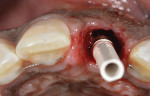 Fig 10. A prefabricated PEEK temporary cylinder was connected to the implant–abutment interface. Note that the prosthetic screw access was at the palatal side of the implant due to the subcrestal angle correction design.