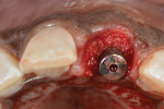 Fig 12. Placement of flat, non-contoured healing abutment. A cross-linked collagen membrane was tucked inside the labial side of the residual socket walls covering the denotalveolar defect, thereby reconstructing a type 2 socket into a type 1. Subsequently, a particle mineralized cancellous allograft was placed between the labial surface of the implant and palatal surface of the membrane into the bone and soft-tissue zones (ie, dual-zone therapy).