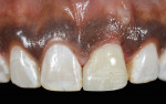 Fig 13. After the healing abutment was removed, the provisional restoration was reseated to contain and protect the graft material during the healing phase of treatment (4 to 5 months).