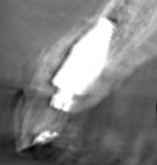 Fig 14. Immediate postoperative CBCT showed reconstitution of the labial bone plate due to the bone chamber created by the body shift of the macro hybrid implant design.