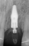 Fig 15. Postoperative periapical radiograph. Note the interproximal bone chamber and greater tooth-to-implant distance for papillae preservation.