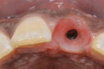 Fig 17. The buccal-lingual ridge dimension shape was preserved and peri-implant soft tissues enhanced using the dual-zone technique and inverted body-shift design implant.
