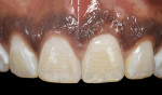 Fig 19. Final implant crown tooth No. 9 and mesial veneer bonded in place. Note the seamless transition in color between the two central incisors.