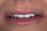 Fig 20. Extraoral smile view of patient. Treatment was delivered in one surgical intervention.