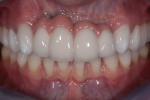 Fig 3. Intraoral frontal. Note long contact between central incisors, a junction line in the pink ceramics between the centrals, and a discrepancy between the pink ceramics and natural soft tissue on distal of lateral incisors-canines. Also, note severe deficiency of bone and poor soft-tissue quality around existing upper implants.