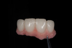 Fig 7. Provisional was relined and modified with pink acrylic. Note the pink extensions on the distal of the lateral incisors to mimic papillae.
