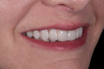 Fig 17. Final smile, lateral view.