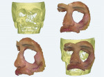 Fig 2. CBCT scan (upper left); face scan aspect using intraoral scanner (upper right); side view of the face scan obtained (lower left); CBCT and face scan aligned (lower right).