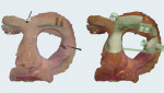 Fig 5. Implants and anchor pins positioned with surgical guide layout (right).