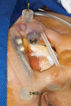 Fig 8. Surgical guide in position for implant placement.