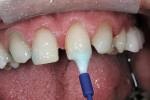 Figure 9: The teeth were etched using phosphoric acid for 10 to 15 seconds and rinsed thoroughly.