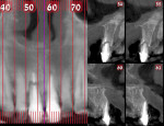 Fig 3. The CBCT depicted a horizontal root fracture at No. 8, considerable bone loss, and
very thin or no labial cortical plates at both teeth.