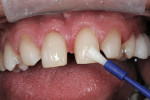Figure 10  The DBA was placed in several coats covering the entire tooth surface.