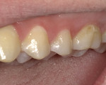 Fig 1. A new patient presented with a white-spot demineralized lesion from an orthodontic bracket on tooth No. 14 that had become cavitated; once cavitated, a white-spot lesion, or enamel demineralization, needs to be restored with either resin-modified glass ionomer or composite. A bioactive composite material, Beautifil Flow Plus X, was chosen to restore this tooth to prevent further deterioration to the tooth structure and maintain an esthetic appearance.