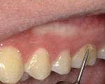 Fig 2. Access to a buccal lesion on tooth No. 14 can be challenging, so a flowable composite was well-suited due to ease of placement. The existing decay was removed using a 330 carbide bur (NeoBurr Carbide, Microcopy, microcopydental.com). The buccal surface of the tooth was beveled 2 mm on all sides (occlusal margin, mesial, distal, and cervical) using a flame-shaped diamond (NeoDiamond Burs, Microcopy), as shown, to create a gradual transition between the tooth structure and restorative material and to enhance retention to prevent microleakage.