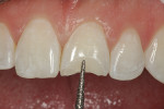 Fig 2. It was, therefore, important to create a long bevel of enamel (3 mm) on the incisal third; thus, 0.5 mm to 0.75 mm of tooth reduction was performed facially with a course diamond (Komet USA, kometusa.com), as shown, to allow the restorative material to have sufficient thickness so it could blend with the natural tooth and have adequate micromechanical retention for bonding and retaining the restoration.