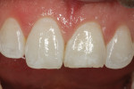 Fig 1. A 30-year-old patient reported complaining that bonding on the incisal edge
of tooth No. 9 “keeps coming off” and that it had been “fixed five times.” Matching direct composite material to a portion of a tooth
seamlessly with surrounding enamel is a challenge, given internal characterization and
the gradation of opacity and translucency in the local area. Also, adequate retention was required for long-term
 success.