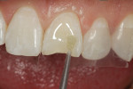 Fig 4. Next, mylar strips were placed in the contact areas, both mesial and distal, in preparation for etching (Select Etch HV®, Bisco , bisco.com) (Fig 3) and bonding (Tokuyama Universal Bond, Tokuyama Dental America) (Fig 4).