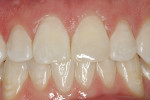Fig 8. Final retracted facial views of the completed restoration on tooth No. 9 demonstrating OMNICHROMA’s ability to provide a beautiful esthetic match.