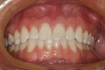 Fig 9. Final retracted facial views of the completed restoration on tooth No. 9 demonstrating OMNICHROMA’s ability to provide a beautiful esthetic match.