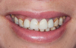 Fig 2. Close-up preoperative smile view.