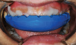 Fig 9. The stint was then placed onto the prepared teeth, as shown. Before the Luxatemp Ultra material sets, all excess material will be wiped away to expose the 1 mm to 2 mm of teeth and incisal papillae.