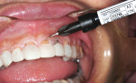 Fig 11. At this point a lower value of flowable composite (LuxaFlow, DMG) was painted onto the gingival areas of the exposed teeth, light-cured, then trimmed and polished. This allowed the provisional to have a polychromatic appearance. Also, because the LuxaFlow can be easily and accurately painted, it can be kept away from the soft tissue, helping to prevent unnecessary trauma to the tissue during the final clean-up and polishing.