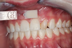 Fig 2. Dentin shade selection was matched to the gingival one-third of tooth No. 9 with DC2 shade.