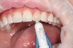 Fig 7. A very thin layer of Aura E2 enamel microfilled composite was added over the dentin build-up.