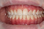 Fig 8. Immediately postoperative photographs showed the final result after composite trimming and polishing. A #12 scalpel was used to trim the gingival margin, and rotary high-speed trimming burs as well as low-speed wheels, points, and disks were used to contour the restoration and create the final luster