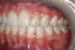 Fig 10. Final photographs at 1-week postoperative showed the anterior build-up on tooth No. 10 completed with Aura Ultra Universal Restorative material.